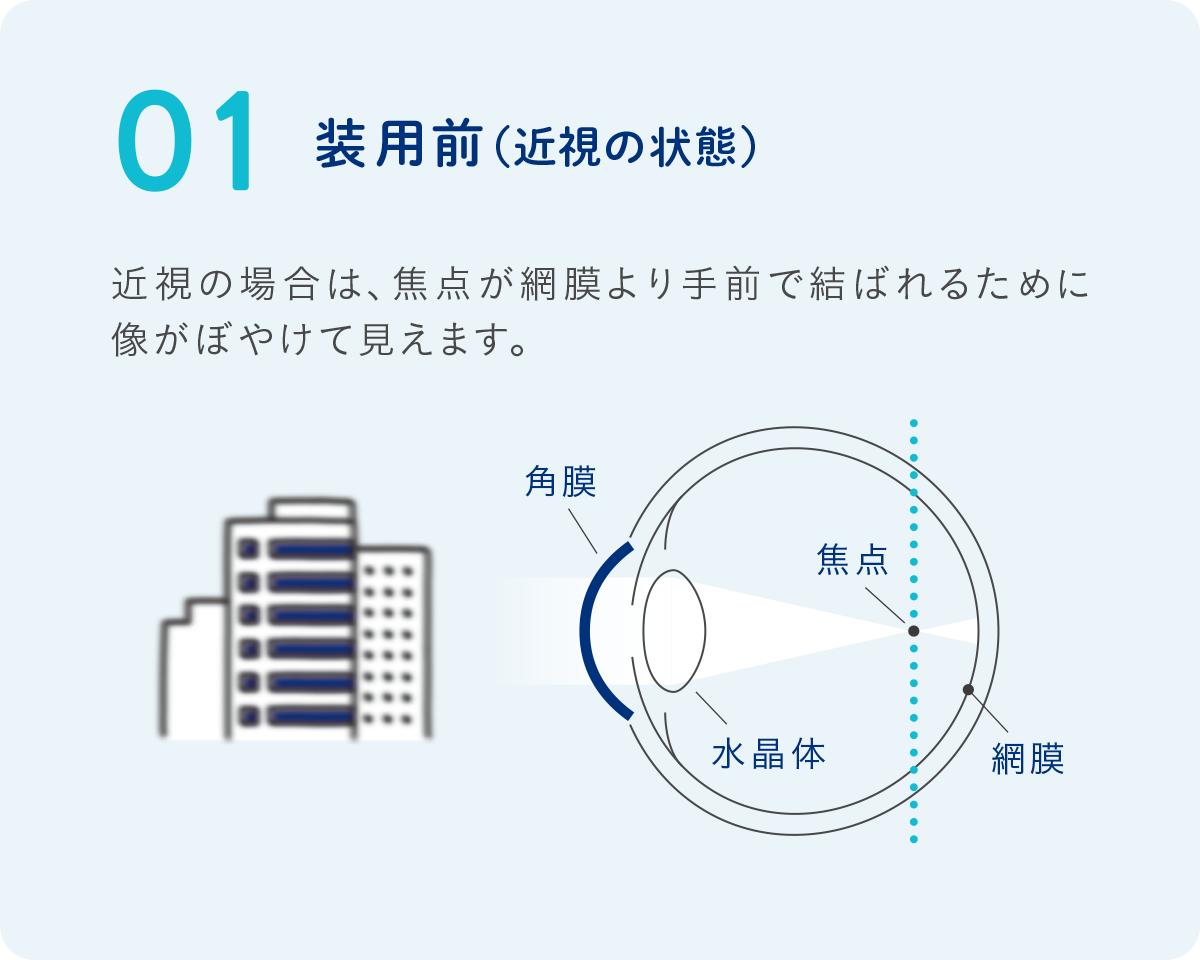 STEP 01 装用前(近視の状態)
焦点が網膜の手前で結ばれ、像がぼやけて見えます。