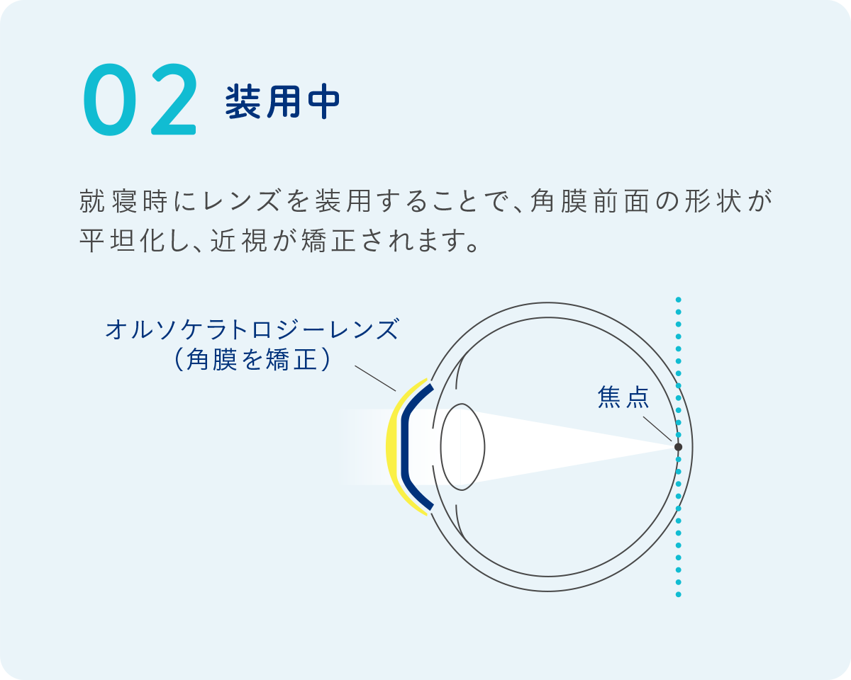 STEP 02 装用中(就寝中)
専用レンズが角膜前面の形状をやさしく平坦化し、近視を矯正します。