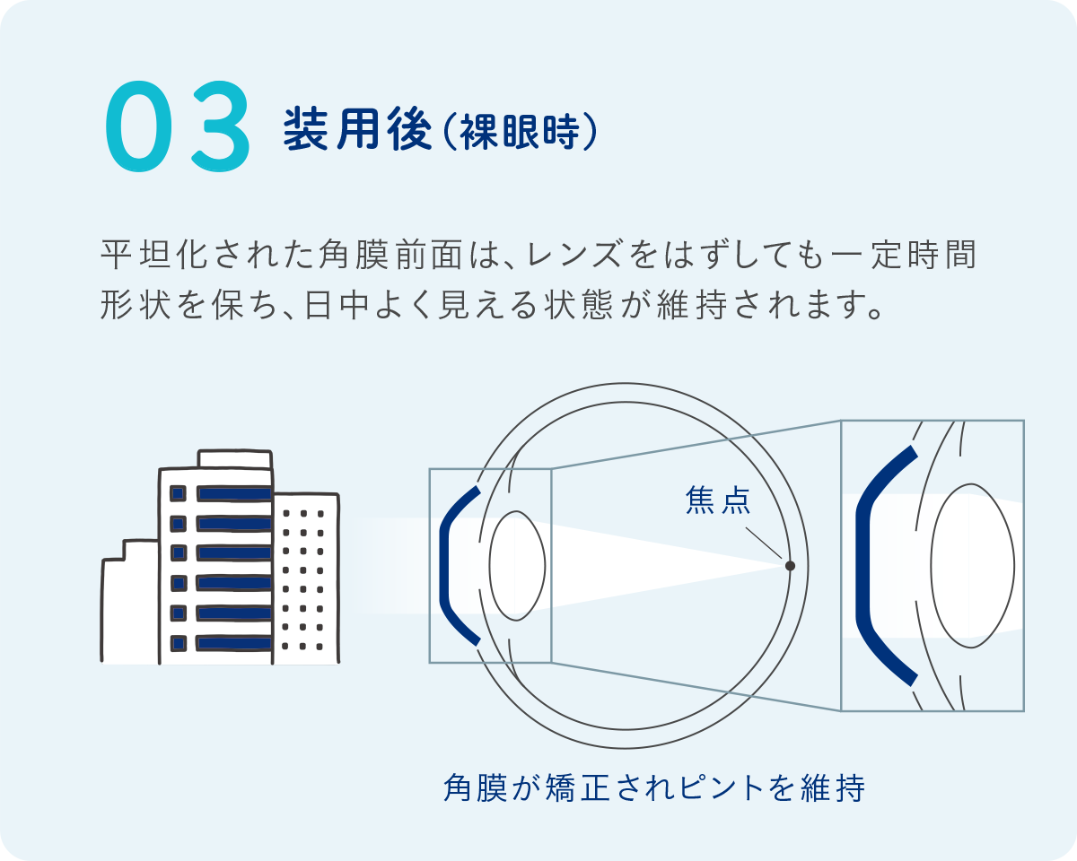 STEP 03 装用後(裸眼時)
レンズを外しても形状は一定時間保たれ、日中は裸眼でよく見える状態になります。